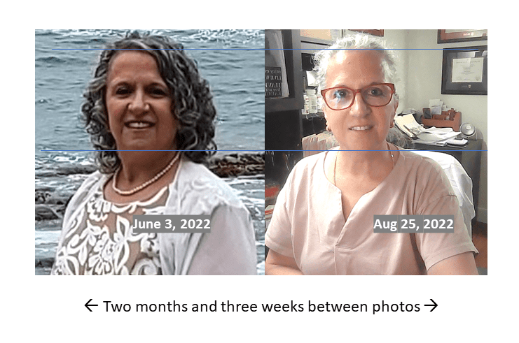 Picture showing the visual effect of almost 3 months on hypothyroid medication