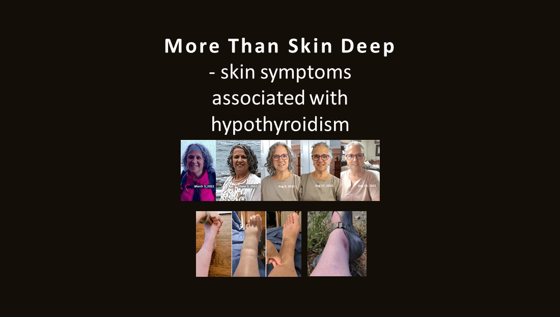 More Than Skin Deep - some skin symptoms of hypothyroidism