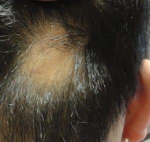 Alopecia areata