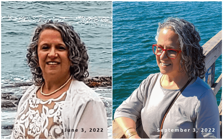 Loss of half my hair in 3 months due to telogen effluvium.