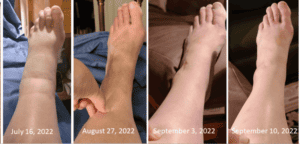 Photos showing resolution of mucin accumulation