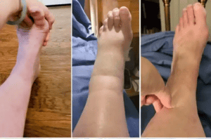 Leg before hypothyroidism, with th edema of hypothryoidism, after 3 months on thyroid hormones