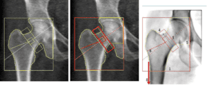 retail image does not measure the neck of the femur at the narrowest part, wherea clinical image does