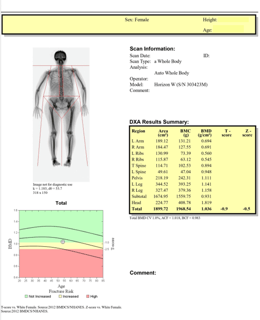 Whole Body Composition Scan - estimation of Bone Mineral Content and Bone Mineral Density