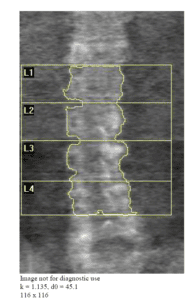 Spinal images from an accredited facilities shows equal amounts of soft tissue on either side of the spine